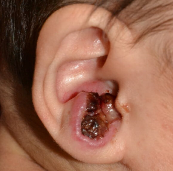 急に増大し、皮膚潰瘍になってしまいました。赤ちゃんは痛みもあり、出血しやすくかわいそうな状態。このまま放置すると場合によっては細菌感染から耳介軟骨炎などを生じ、高度な耳介変形をきたす可能性がありましたのでヘマンジオルシロップ内服治療を行いました。
