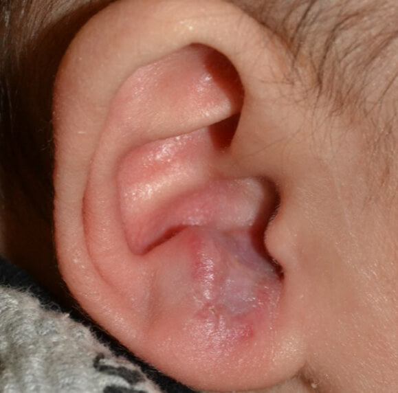 内服開始後2週間です。効果が著明です。生後10か月まで内服治療を続けました。