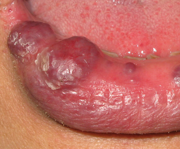 唇に生じた静脈奇形