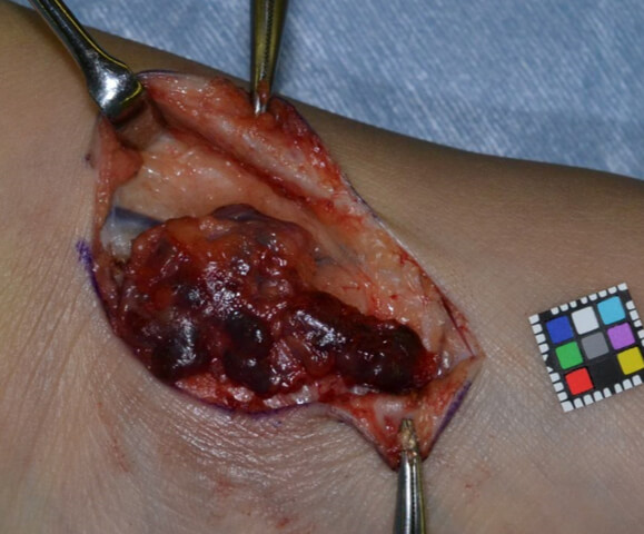 足首にあった静脈奇形を手術で摘出したところ