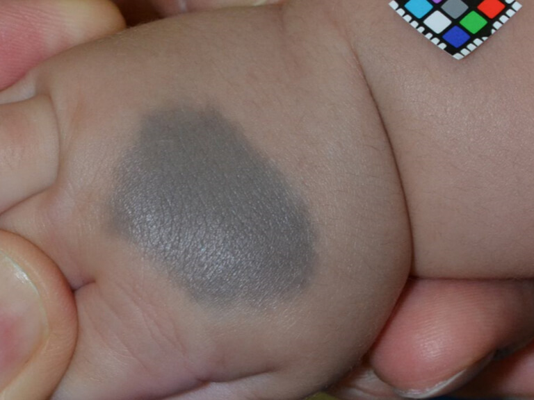 赤ちゃんの手背にあった異所性蒙古斑。このぐらい濃い色だと将来的に残る可能性が高いため、Qスイッチルビーレーザー治療を行いました。保険診療で3か月以上の間隔をあけ、3回の照射を行いました。