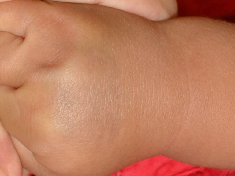 術後の様子です。よく見るとわずかに色が残っていますが、これは自然に治ります。早く治療できてよかったですね。