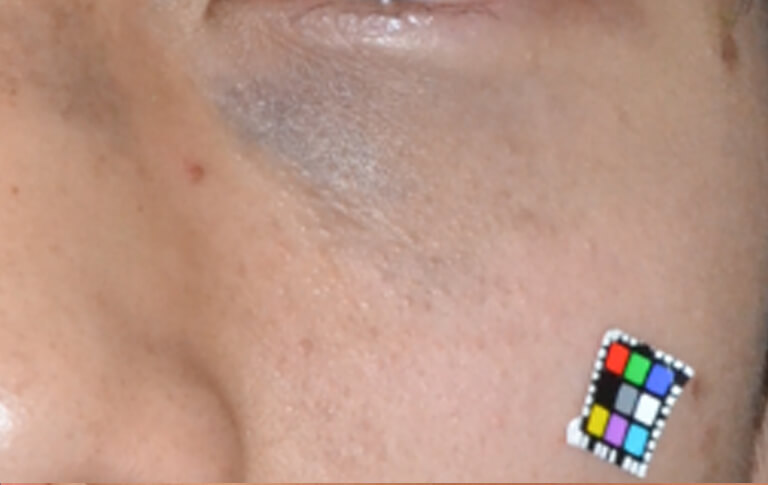 左下眼瞼の太田母斑です。保険診療でQスイッチルビーレーザーを照射しました。痛みが強いため、部分的に注射の麻酔を併用しました。