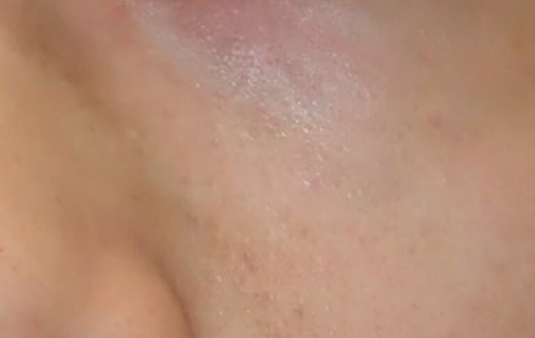 3か月以上の間隔をあけて、4回照射後です。色調はほぼ目立たなくなり、気にならなくなりました。