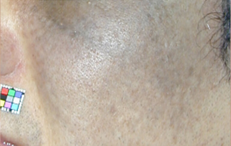 太田母斑。顔面片側あるいは両側に青いあざがあります。