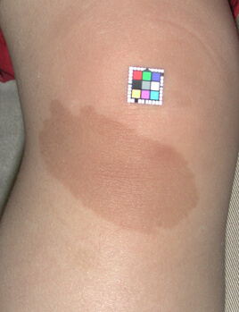 ひざの扁平母斑