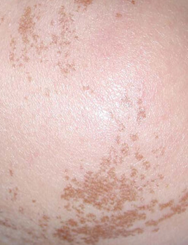 レーザー前・顔面頬部扁平母斑。褐色斑が散在しています。赤ちゃんの右頬です。