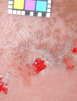 レーザー照射直後 よく反応し一部皮膚がめくれています。1週間ほどで治癒します。