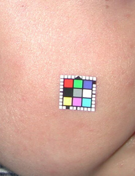 術後半年。大変よく効き、再発はありませんでした。ここまで完全に消失するのは珍しい症例です。