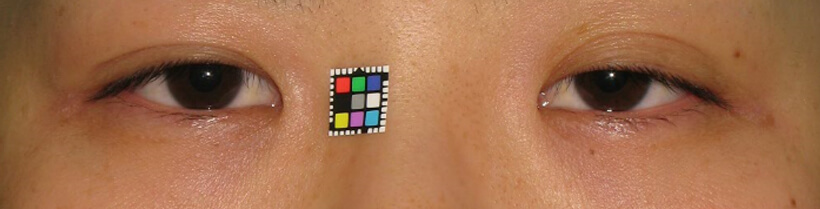 術前。左眼瞼下垂があります。