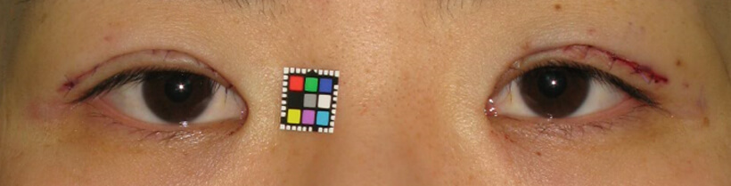 手術直後。バランスを取るため右も手術を行っています。