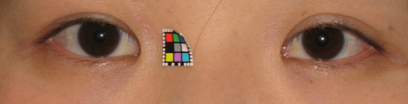 術後半年。自然な形態になっています。