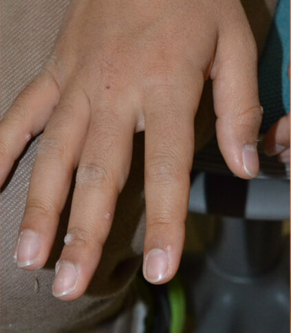 多発した手のイボ