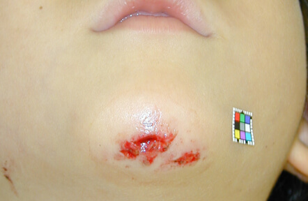 転んで顎を切りました。よく受傷する部位です。縫合治療を行いました。