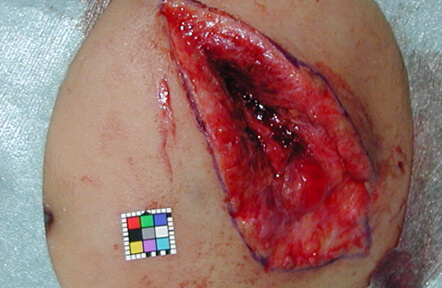 左頬を大きく切ってしまった方です。創縁をきれいに整えて縫合しました。