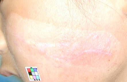 3か月後です。まだ傷跡が目立ちます。テーピングを継続しました。