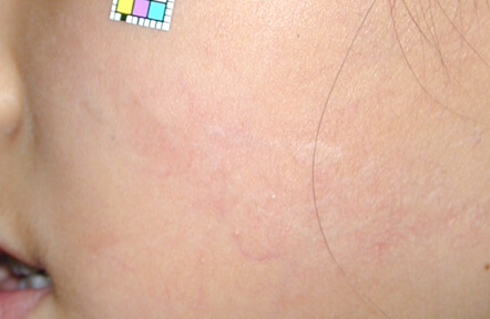 術後1年です。ほぼ目立たなくなりました。