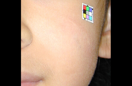 前から見てもあまり目立たない傷跡になりました。