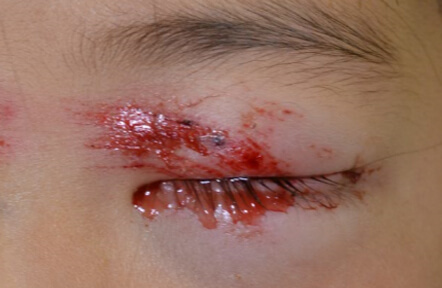 やぶに顔から突っ込んでしまい、目の周りを切りました。涙小管という涙の通り道が断裂していました。