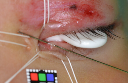 金属の棒が通っているのが涙小管です。涙小管の吻合とシリコーンチューブ留置をおこない、閉塞を防ぎます。