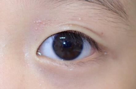 受傷後3か月です。瘢痕も目立たず、流涙もありません。