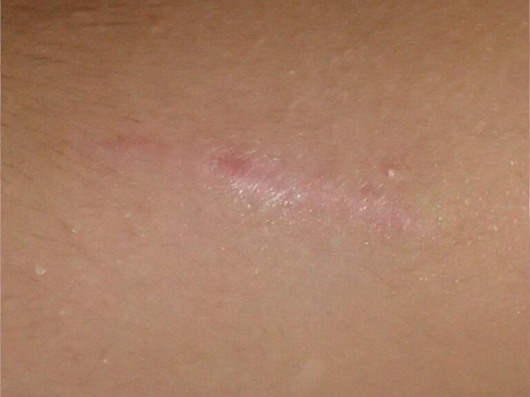 切除手術 術後半年。まだわずかに赤みが残っています。