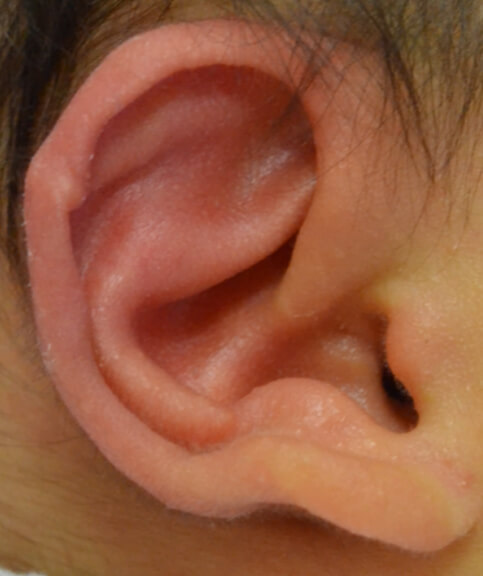 矯正後1か月の様子です。