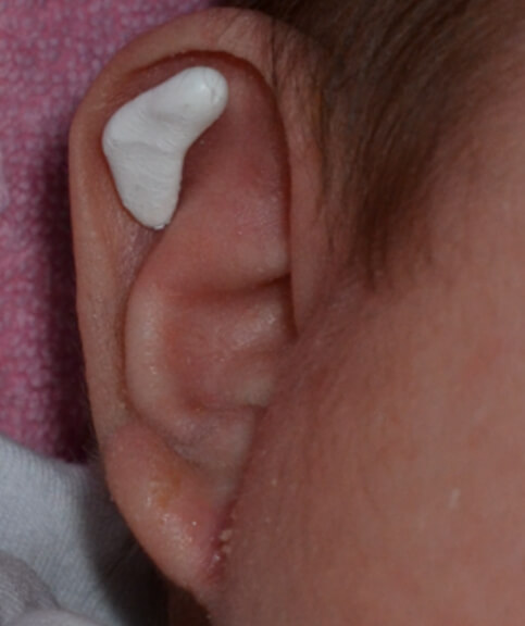 とびだしているところに装具を当てて、テープ固定をします。