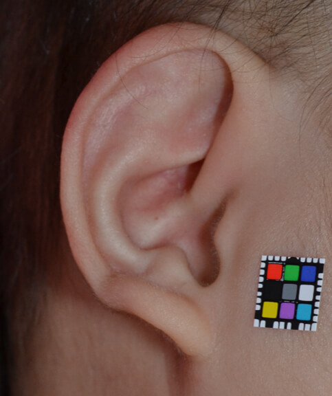 生後半年の耳の形。正常な形に矯正されました。耳の矯正は保護者の方の努力も忘れてはならない要素です。