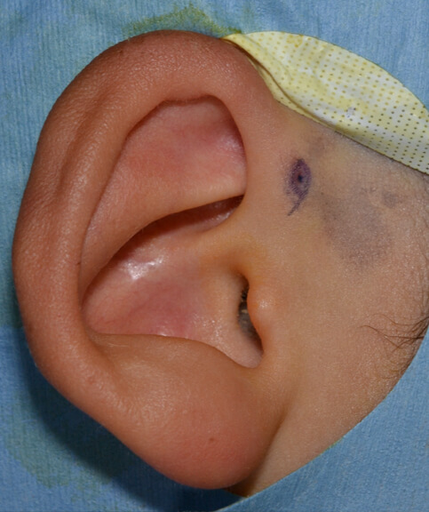 切除手術を行いました。