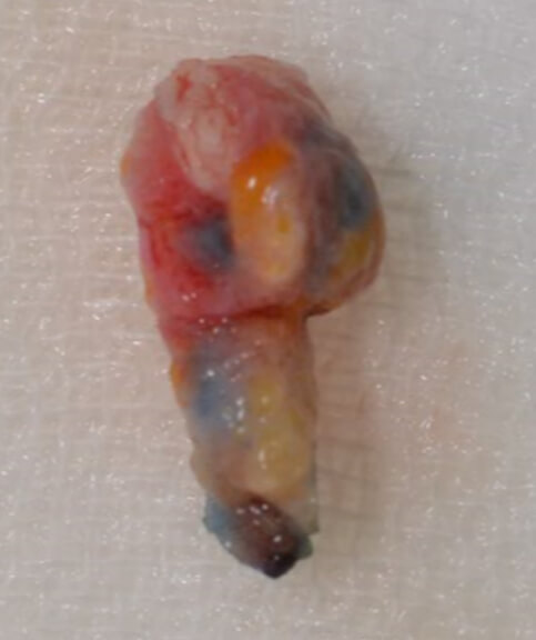 摘出した瘻孔。内部を染めてあります。