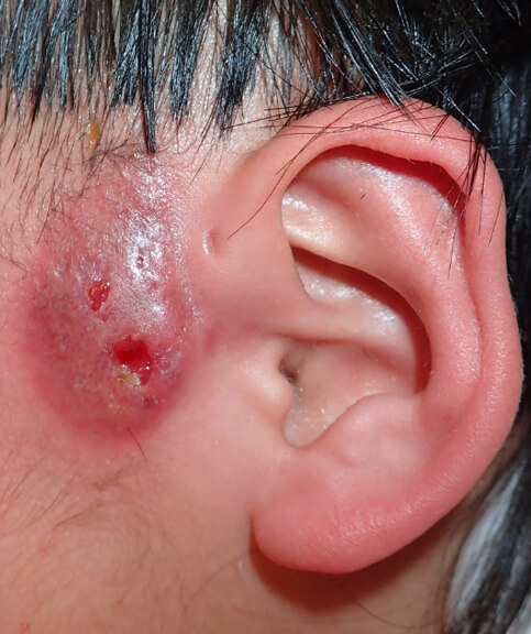 感染して耳の前がパンパンに腫れています。