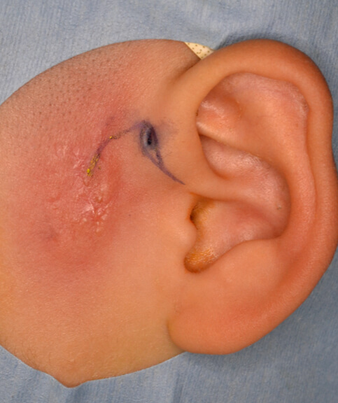 汗腺が落ち着いたところで瘻孔摘出しました。