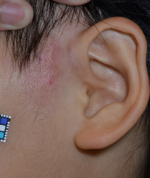 後半年。傷跡も少なく、再発もありません。