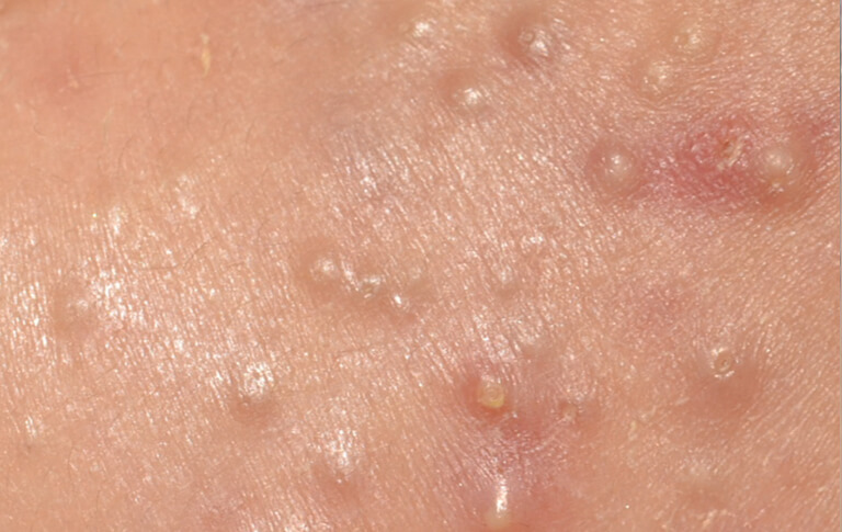 多発する面皰