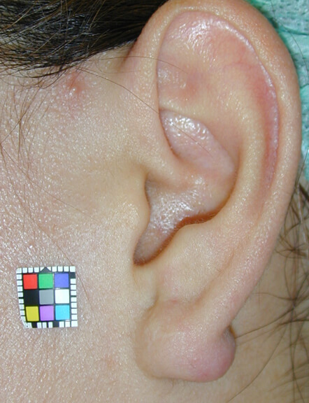ピアスによるケロイドを生じています。ピアス孔はすでに閉塞しています。