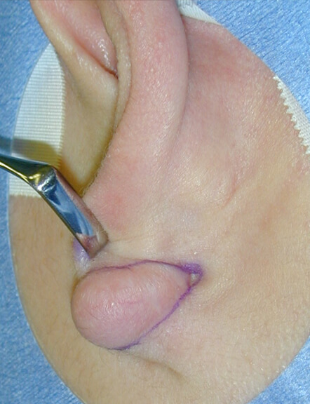 切除手術を行いました。