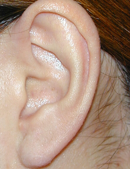 術後です。耳の形は改善しました。