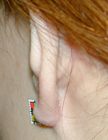 この方は再発せずに済みましたが、常に注意が必要です。