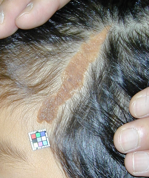 左側頭部の脂腺母斑です。