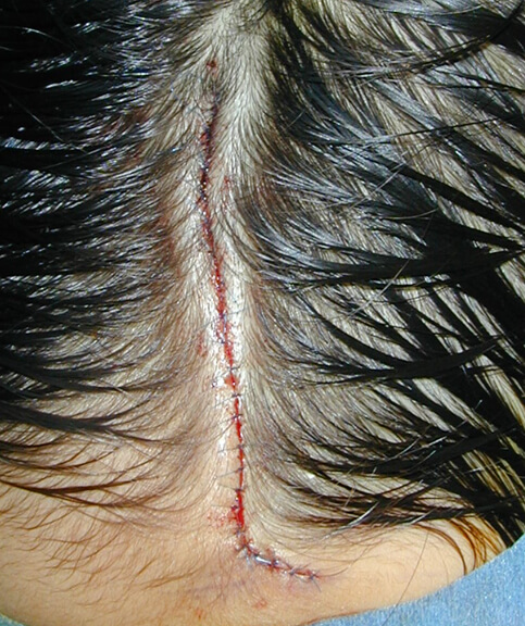 切除し、特殊な方法で縫合しました。 この方は全身麻酔での手術を行っています。