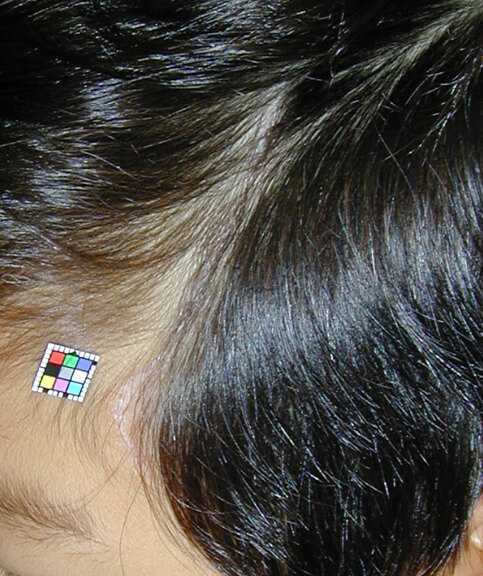 ほとんど脱毛を残さずに治癒しています。