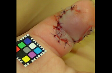 縫合後。血流も問題ありませんでした。