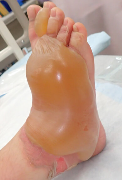 2度熱傷ですが、ほぼ深達性2度熱傷で結局植皮手術をおこないました