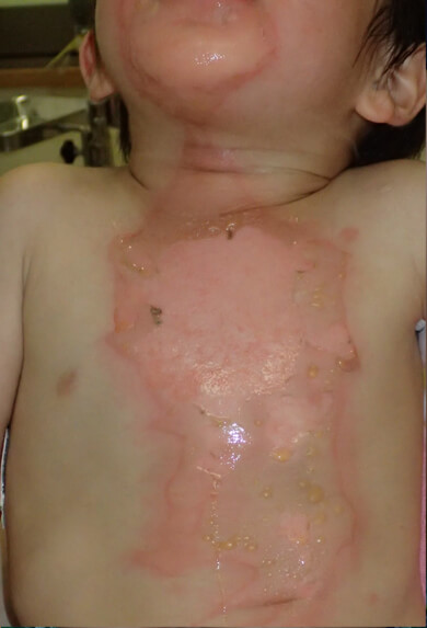 お湯によるやけど