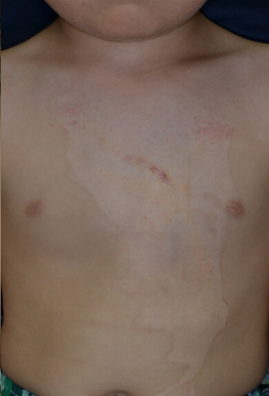 受傷後1年です。